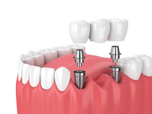 3D Dental Imaging