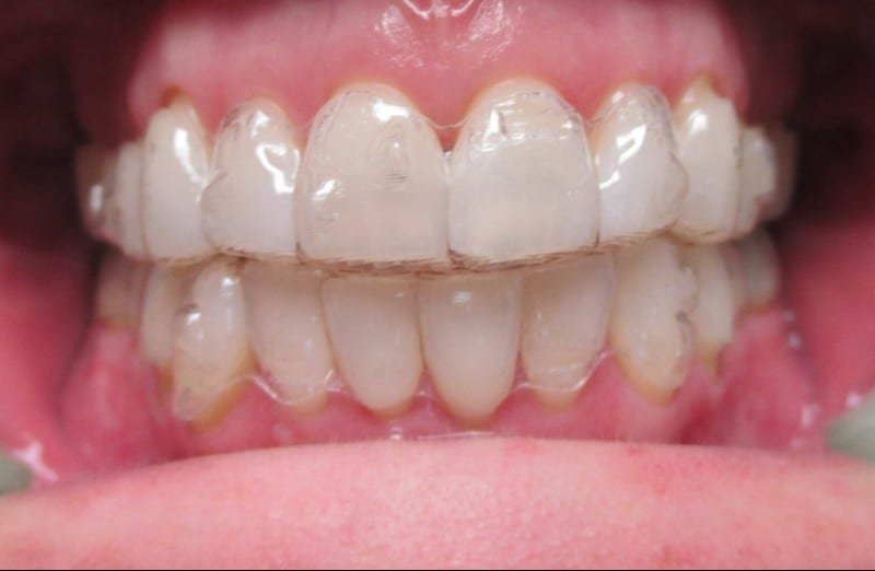 Invisalign Aligners