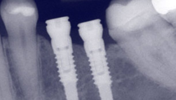 Dental Implants