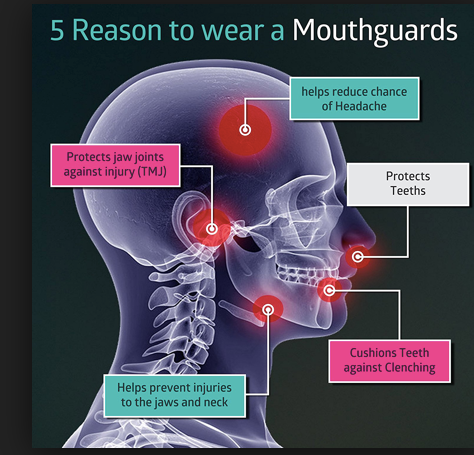 5 Reasons to wear a Mouthguard