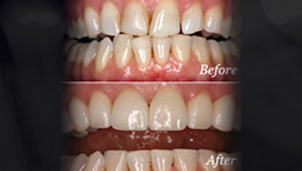 Veneers