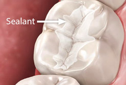 Dental Sealants