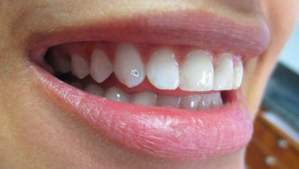 Dental Diamonds