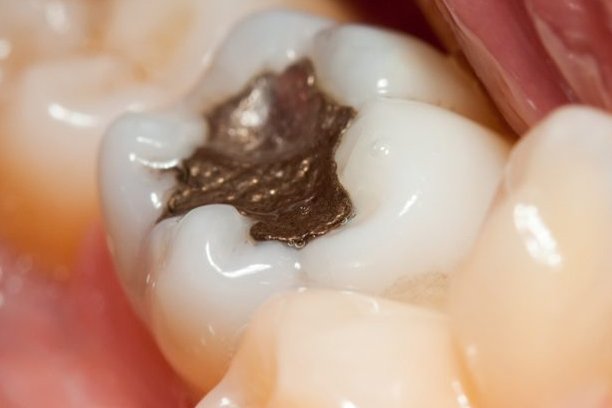 Fillings Image 1