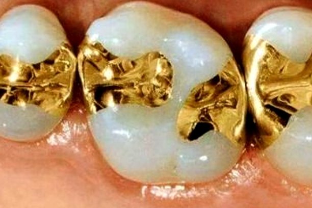 Fillings Image 2