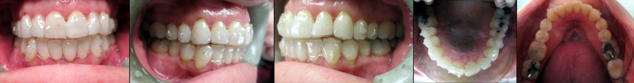 Invisalign Treatment Progress