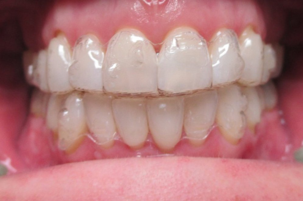 Invisalign Post 3