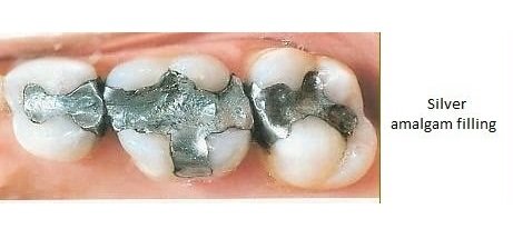 Fillings Image 1