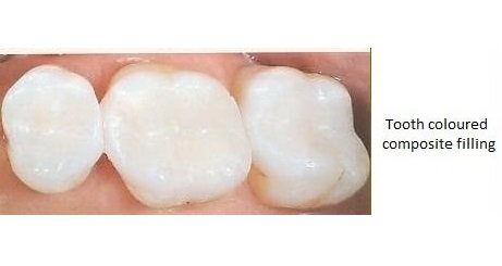 Fillings Image 2